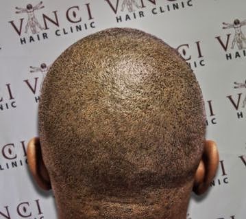 Vinci Hair Clinic